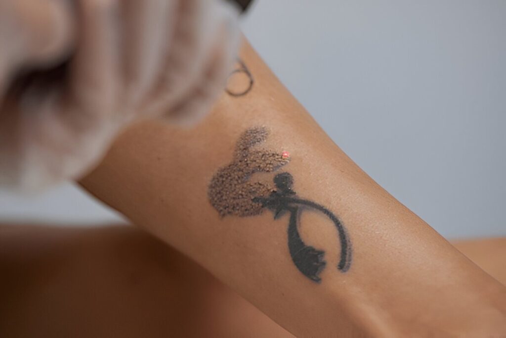 Body Tattoo Removal in Dubai at Angel Tattoo Studio
